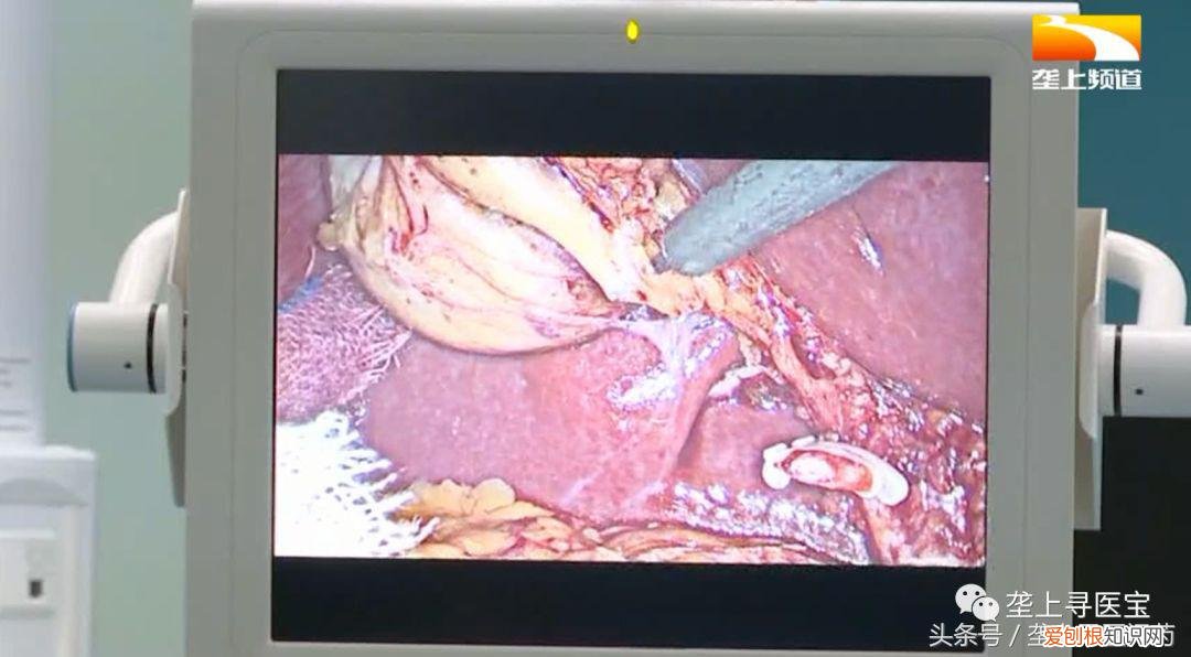 腹腔镜手术视频