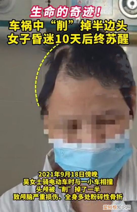 女子车祸半边头被削掉 竟奇迹存活