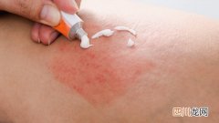 湿疹怎么治疗？ 湿疹的外用秘方有几个？