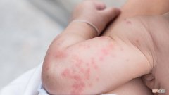 婴儿生理性腹泻有什么特点？预防宝宝腹泻注意这4点