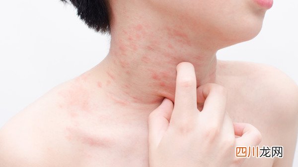 四大因素造成宝宝湿疹 宝宝湿疹试试蛋黄油