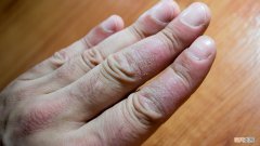 喝茉莉花茶能治疗牛皮癣吗 治疗牛皮癣要正确科学