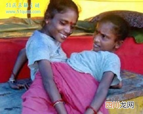 印度连体兄弟拒绝分离 兄弟两人共享4只胳膊和2条腿