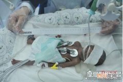 组图 中国最小的婴儿仅重250g，李思源660g纪录被改写