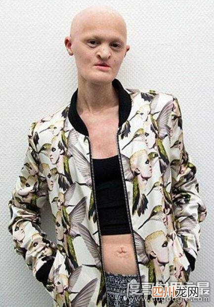 组图 世界上最丑女模特盘点，梅勒妮·盖多斯最值得敬佩