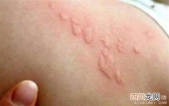 看上去吓人 螨虫咬了是什么样子图，起红疙瘩还痒