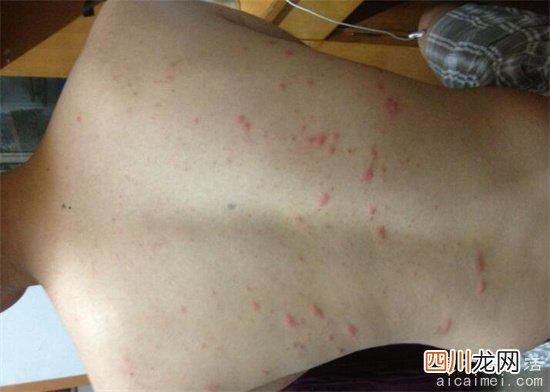 看上去吓人 螨虫咬了是什么样子图，起红疙瘩还痒