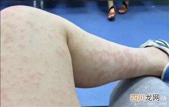 看上去吓人 螨虫咬了是什么样子图，起红疙瘩还痒