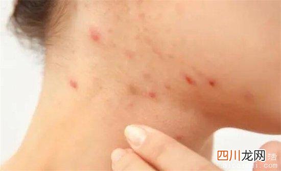 看上去吓人 螨虫咬了是什么样子图，起红疙瘩还痒