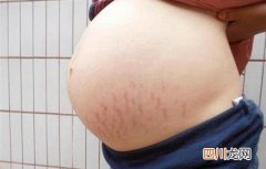 孕后肚子上难看的妊娠纹怎么去除 妊娠怎么去掉
