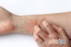 身上长湿疹很痒怎么办 湿疹止痒妙招